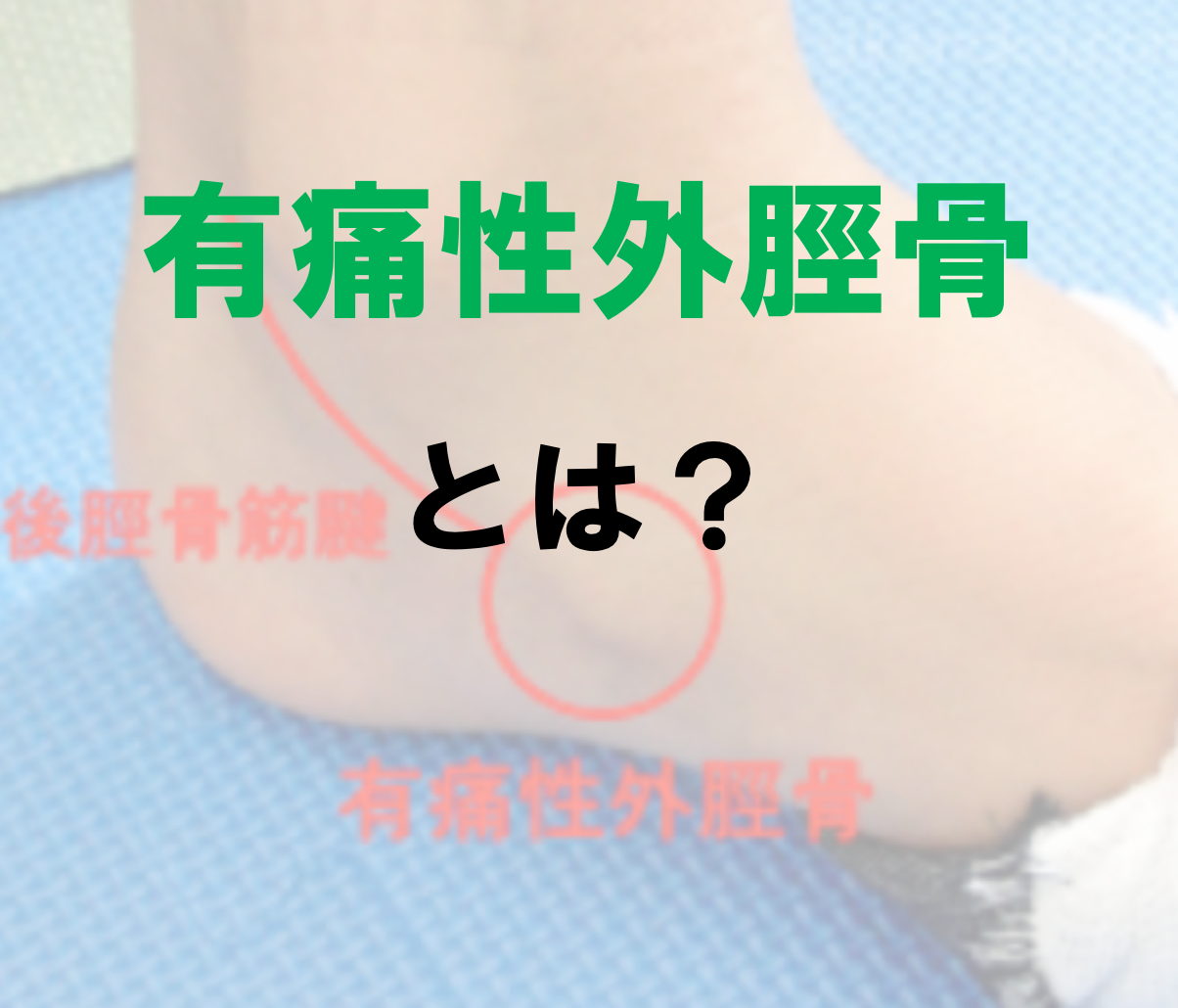 有痛性外脛骨（ゆうつうせいがいけいこつ）とは 筋膜調整のトリガーLABO